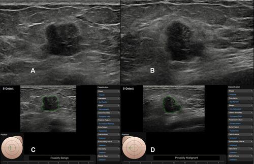 Figure 4 US images in a 54-year-old woman with Her-2 positive invasive ductal carcinoma. Conventional ultrasound images show 15-mm hypoechoic mass with irregular shape (A and B), which was classified as BI-RADS 4B. The CAD system diagnosed it as “probably benign” based on the image in the antiradial plane (C) and “possibly malignant” based on the image in the radial plane (D).