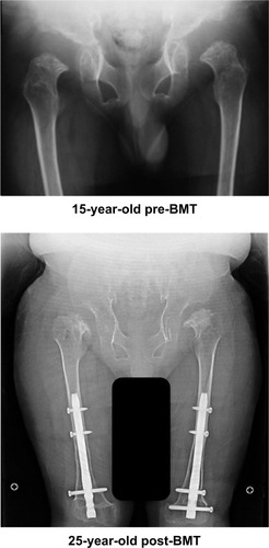 Figure 3 X-ray of hip joints.