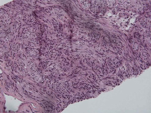 Figure 2. Pathology H&E stains of core biopsy. Spindle cells are seen.