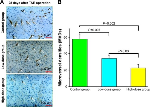 Figure 5 Effect of VEGF siRNA combined with lipiodol (TAE operation) on the microvessel densities (MVDs) of liver tumors induced by inoculation of VX2 tumor into liver of rabbits by immunohistochemical staining.