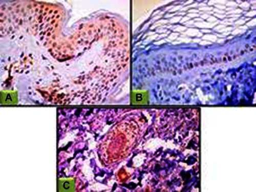 Figure 2 JAK1 expression in perilesional skin sections.Abbreviation: JAK1, janus kinase 1.