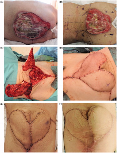 Figure 3. (A) Lumbo-sacral defect extending from L4 to S4 (B) Preoperative skin markings with perforators. (C) Intraoperative flap raising after extensive bone debridement (head of patient on the left, feet on the right). (D) Venous congestion on the left LAP flap right requiring stich removal and partial secondary closure. (E) Uneventful healing after secondary closure. (F) Postoperative follow-up (three months).