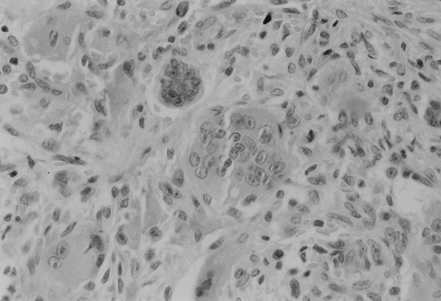 Figure 3. Trabecular bone replaced by brown tumor consisting of the fibroblastic stroma with areas of hemorrhage. Multiple giant cells scattered between the spindle cells (HE).