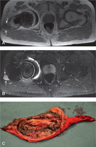 Figure 1. Images from a 70-year-old man who had undergone total hip arthroplasty of the right hip 3.4 years earlier. He had a tingling sensation in the trochanteric region and the replaced right hip made clacking sounds. Whole-blood metal ion levels were slightly elevated (cobalt 7.5 ppb and chromium 5.8 ppb; normal reference values are < 0.8 ppb for Co and Cr). Axial view of a thin-walled cystic pseudotumor in the greater trochanteric region (arrows) with fluid-like low signal intensity in T1 (panel A) and high in STIR (B). A thin-walled and fluid-filled pseudotumor with metal staining was encountered at revision surgery (C).