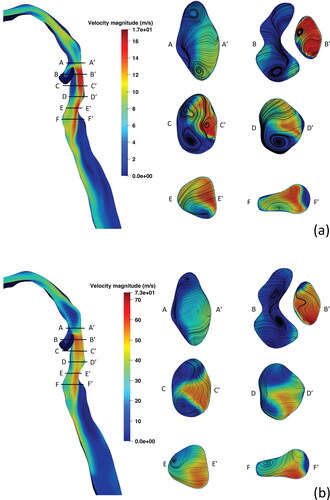 Figure 7. Mid-sagittal instantaneous velocity contours and axial cross-sections through the supraglottis with secondary velocity streamlines at (a) Q = 60 L/min and (b) Q = 240 L/min.