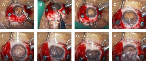 Figure 2 Surgical procedure of a case with a subluxated lens. (A) One arm was inserted into the corneal side port using forceps. (B) The elastic silicone sheet (ESS) was inserted into the eye behind the subluxated lens through a 3-mm corneoscleral incision and zonular dialysis. (C) The other two ends of the arms were inserted through the corneal side ports. (D) Phacoemulsification and aspiration (PEA) was performed on the ESS. (E) After the PEA was completed, the two arms were dissected. (F, G) The remaining arm was caught and pulled out. (H) The ESS was easily removed through the corneoscleral incision.