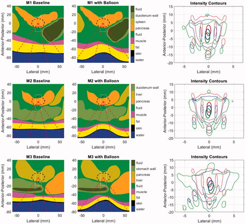 Figure 8. Geometries for the baseline (left) and balloon-deformed (center) configurations of each patient model. Overlaid lines indicated the annular ‘cone’ of the incident HIFU beam (dashed red), the PDAC target (dashed black) and the window in which intensities are displayed in the right-side panels (thin white). Intensity contours at 0.7 (thick line) and 0.033 (thin line) are overlaid in the same central axial plane of the models as displayed in the left and center panels, with colors denoting an idealized water path (red), baseline tissue (blue) and balloon-deformed tissue (green). Upper row: M1 (70 mm target depth), Middle row: M2 (66 mm target depth), Lower row: M3 (55 mm target depth).