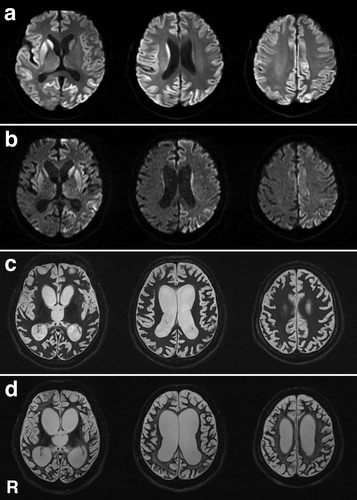 Figure 6. Magnetic resonance images of the brain. (a) Diffusion-weighted images (DWI) obtained 2 weeks after symptom onset show extensive hyperintense regions in the cerebral cortical ribbon and striatum, particularly on the right side. (b) DWI obtained 4 months after symptom onset shows extensive hyperintense regions of the cerebral cortex and striatum, particularly on the left side. Brain atrophy is mildly progressed. (c) T2-weighted images obtained 12 months after symptom onset show general cerebral atrophy and lateral ventricular dilatation. White matter degeneration is still not apparent. (d) T2-weighted images obtained 24 months after symptom onset show severe cerebral atrophy and lateral ventricular dilatation. White matter degeneration is recognized. R, right side