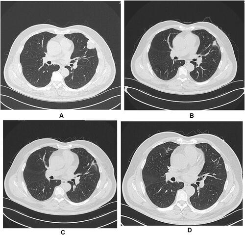 Figure 1 Computed tomography findings before and after treatment with alectinib. A computed tomography scan before treatment revealed a solitary tumor in left upper lung (A). A computed tomography scan 1 months after commencing treatment with alectinib revealed that dramatic reduction in tumor size (B and C), almost no presence of tumor lesion (D).