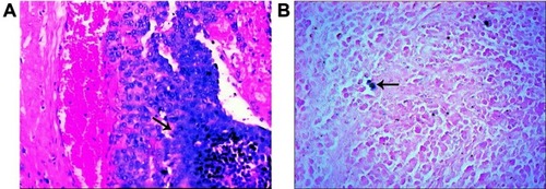 Figure 3 Histopathological staining of PVTTs. (A) showed the tumor thrombus (arrow) in portal vein with HE staining. (B) showed iron particles (arrow) with Prussian blue staining.Abbreviation: PVTT, Portal vein tumor thrombus.