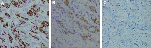 Figure 1 Representative high mobility group box-1 immunohistochemistry staining in breast cancer tissues (A), patients with benign breast disease (B) and healthy subjects (C).