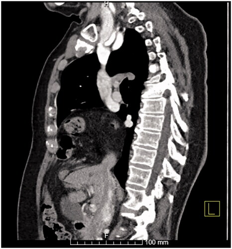Figure 2. A sagittal view of a Morgagni hernia from a CT scan showing the defect in the anteromedial part of the diaphragm and the bowel herniated into the thoracic cavity.