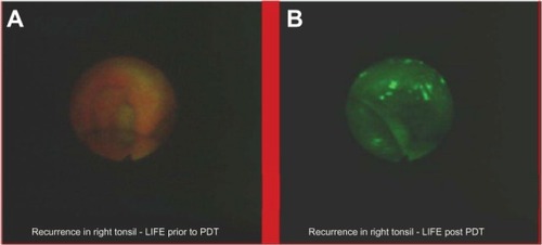 Figure 11 Recurrence of squamous cell carcinoma in right tonsil before (A) and after (B) photodynamic therapy.