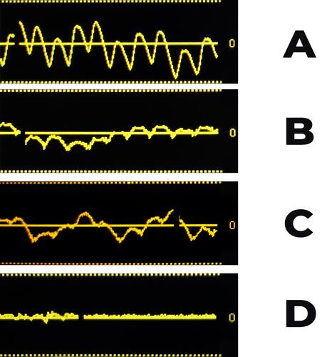 Figure 1 Illustration of epidural waveforms representing (A) strong, (B) weak, (C) weak with respiratory pattern and (D) absent. When accessing the presence of a positive waveform in the weak category, greater attention should be focused on details, as the vertical height of the amplitude of waveform is reduced.