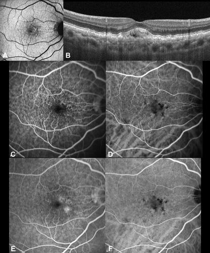 Figure 5 Cuticular drusen associated with vitelliform detachment. (A) Fundus autofluorescence demonstrating hyperautofluorescent signal in correspondence of vitelliform material.; (B) Subfoveal optical coherence tomography B-scan shows discrete retinal pigment epithelium-basal lamina (BL) elevations compatible with cuticular drusen and a subretinal accumulation of hyperreflective material consistent with a vitelliform detachment. (C) Fluorescein angiography (FA) at 0:50 seconds demonstrates a starry-sky appearance; this aspect is also detectable through indocyanine green angiography (ICGA) visible at (D) The starry-sky appearance is maintained in late angiograms (6:42 min) of FA (E) and ICGA (F). Additionally, late staining of vitelliform material can be appreciated with FA, while a central hypofluorescence is visible with ICGA.