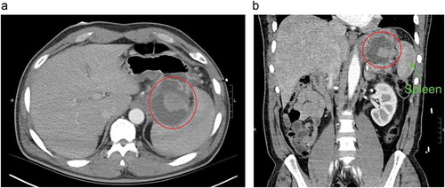Figure 1. Computed tomography (CT) scan of abdomen (a) transverse view, (b) coronal view both showing hyper-dense lesion surrounded with peripancreatic fluid collection at the hilum of the spleen (red circle).