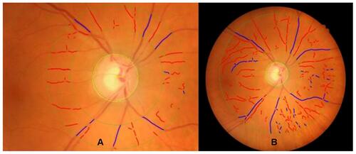 Figure 1 Example of an analyzed fundus photo.
