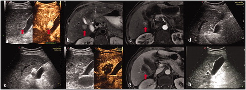 Figure 1. A 55-year-old male. (a, b, c) Contrast-enhanced ultrasound and MRI indicated a small liver tumor located in segment 5 abutting the gallbladder with a maximum diameter of 14 mm. (d, e) The electrode was inserted parallel to the gallbladder wall with a minimum distance of 10 mm. (f) Contrast-enhanced ultrasound demonstrated a complete ablation and intact perfusion of gallbladder wall. (g) Contrast-enhanced MRI one month after the ablation procedure confirmed the technical efficacy. (h) Normal gallbladder wall was showed in the follow-up period.