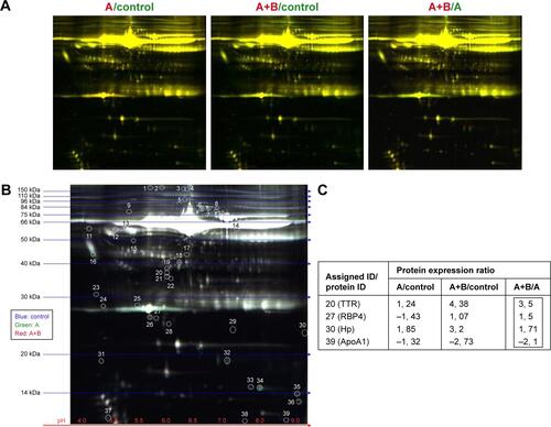 Figure S1 Proteome profiling indicating alterations in the expression levels of human proteins evoked by the consumption of aspirin alone or combined with caffeine at clinically attainable doses.Notes: Proteomic analysis in the serum of a 33-year-old healthy female individual 16 hours after the consumption of 500 mg of a marketed (ASPIRIN 500MG/TAB, Bayer Hellas A.B.E.E., Marousi 151 25, Attiki, Greece) tablet of aspirin (“A”) or a marketed (KALMALINE AC [500+30]MG/TAB, Coup A.B.E.E., Agias Varvaras 53, P.C. 17235 Athens, Greece) tablet containing 500 mg of aspirin and 30 mg of caffeine (“A+B”). None of these pharmacologic agents or even a placebo pill was consumed by the volunteer in the case of “control” serum analysis, while the individual voluntarily did not consume any food or beverage containing caffeine (chocolate, tea and so on) at least 24 hours before any of the three distinct blood sample collections, which took place throughout a 3-day period (ie, 1st, 2nd and 3rd days when control, sample A and sample A+B were collected). Approximately 8 mL of blood was collected in serum separating tubes (BD Vacutainer SST II 8.5 mL Advance Tubes-367958; Scientific Diagnostics Ltd, Attiki, Greece), and 2 mL of serum obtained after sample centrifugation for 15 min at 3,000 rpm was transferred into cryovials (Greiner Bio-One GmbH 5 mL U-Bottom cryovials CE-IVD; Bioline Scientific, Athens, Greece) and stored at −20°C, until their transfer in dry ice shortly after (1 day) the completion of the 3-day sample collecting period. All the experimental procedures associated with 2D-DIGE from protein extraction and sample labeling with CyDye DIGE fluors (blue, green and red for “Control”, “A” and “A+B” samples, respectively) to spot picking and protein identification by mass spectrometry were performed at Applied Biomics (Hayward, CA, USA) according to the established protocol as it has been described elsewhere.Citation1 Shown here (A) are 2D-DIGE gel images from overlay of each paired sample, A/control, A+B/control and A+B/A. The protein spots shown in yellow color means that protein expression is similar in the paired samples (two-color image overlay). White color (B) means that the protein expression is the same in all these samples (three-color image overlay). For the aforementioned three paired comparisons, a fold ≥1.3 was used as a cut-off value in the DeCyder analysis and most significant changed spots were selected. All the 39 spots were circled and numbered in the triple color overlay gel image with the estimated MW and isoelectric point (pI) grid (C). Each spot number was assigned (Assigned ID/protein ID) if the ratio of changes in at least one paired sample was ≥1.3 fold. Some of the statistically significant spot ratios corresponding to the expression of the 15 proteins which were mostly affected (either positively or negatively) in the A+B/A paired sample were chosen for identification by mass spectrometry. The rationale for focusing on this category of proteins is based on the fact that these proteins indicate the differential biologic outcome of aspirin when it is received in combination with caffeine (“A+B” or the numerator of the fraction) or not (“A” or the denominator of the fraction), respectively. Mass spectrometry revealed that the ID of four randomly chosen spots (C, shown as boxed values of the “A+B” paired sample) corresponding to the 15 most influenced proteins in the A+B/A paired sample is TTR (protein expression ratio 3, 5, spot number 20), RBP4 (protein expression ratio 1, 5, spot number 27), Hp (protein expression ratio 1, 71, spot number 30) and ApoA1 (protein expression ratio −2, 1, spot number 39). The role of these proteins in tumorigenesis and/or cancer diagnosis/prognosis is discussed in the text.Abbreviations: 2D-DIGE, two-dimensional difference in gel electrophoresis; ApoA1, apolipoprotein A1; Hp, haptoglobin; MW, molecular weight; TTR, transthyretin; RBP4, retinol-binding protein 4.