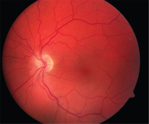 Figure 1 Color fundus photograph of a normal left eye.