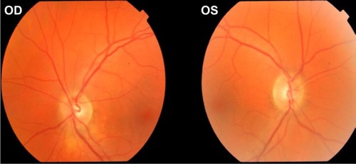 Figure 1 Fundus exam of a patient with ON on the right eye (OD).