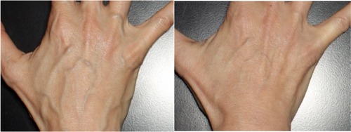 Figure 5 Patient at baseline (left) and Week 12 after receiving three SP-HA injections in the hands (right).