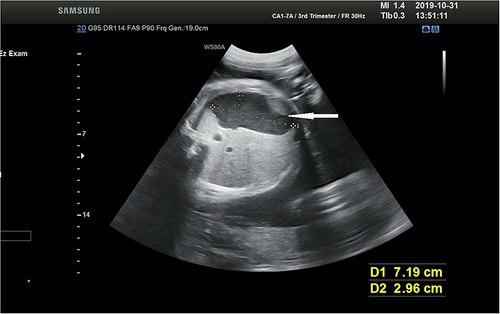Figure 2 Ultrasonography shows an enlarged fetal stomach bubble.