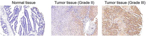 Figure 1. CHPF was upregulated in cholangiocarcinoma