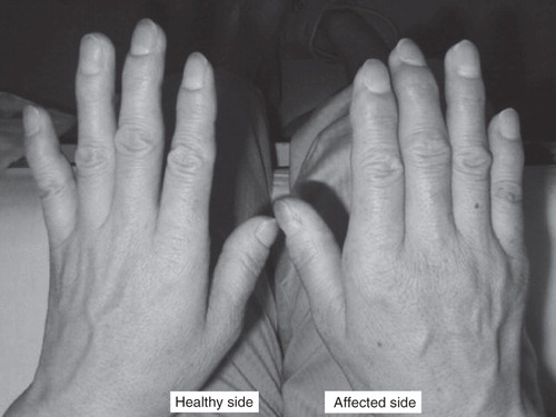 Figure 6. Case presentation. Swelling occurred in the hand on the affected side (right hand) in postoperative week 4, a characteristic and a definitive finding for the diagnosis of phase 1 shoulder-hand syndrome.