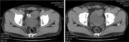 Figure 1 CT: ovoid cystic mass with heterogeneous enhancement left anterolateral to bladder with 55 × 43 × 48 mm dimensions.