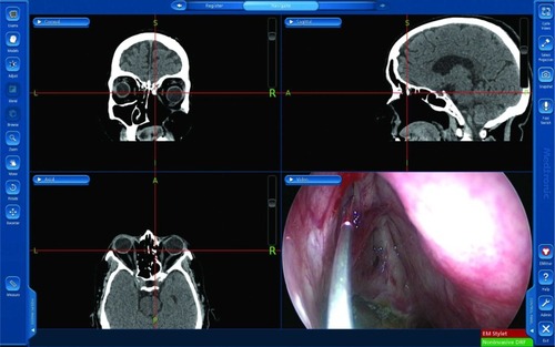 Figure 2 Case 1: Image-guided dacryolocalization view showing the coronal (upper left), sagittal (upper right) and axial (lower left) CT images, as well as the endoscopic view (lower right).