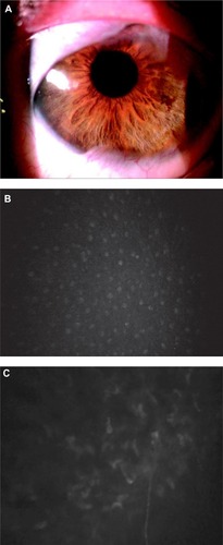 Figure 2 Postoperative evaluation by means of slit-lamp and corneal confocal microscopy.