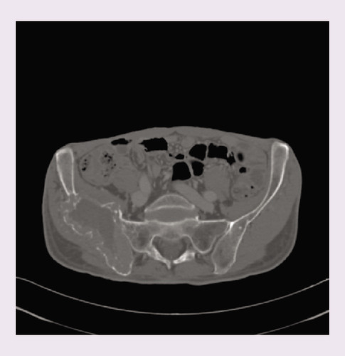 Figure 1. CT scan prior to embolization demonstrates a large locally invasive mass of right iliac bone.