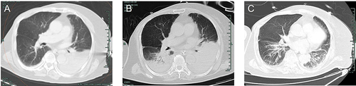 Figure 1 Chest computed tomography (CT) scans of a 77-year-old woman with severe C. psittaci pneumonia. CT scan (October 12) revealed a large consolidation in the left lung and a minor presence of pleural effusion on the left side (A); CT scan (October 16) revealed a worsening of the lung consolidation compared to the previous scan (B); CT scan (November 2) revealed a noticeable reduction in the exudation of both lungs compared to previous scans (C).