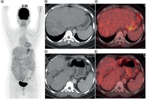 Figure 3. Post-treatment positron emission tomography-computed tomography scan of the 49-year-old female patient described in Figure 2 after 12 months of pazopanib-based therapy.(A) Maximum intensity projection image FDG PET-CT showing physiologic tracer uptake in brain, myocardium and urinary bladder and no abnormal tracer uptake in the hepatic region. (B & D) Axial CT abdomen showing confluent hypodense lesions in both the lobes of liver. (C & E) There is no significant abnormal tracer uptake in fused PET-CT images suggestive of complete metabolic response.