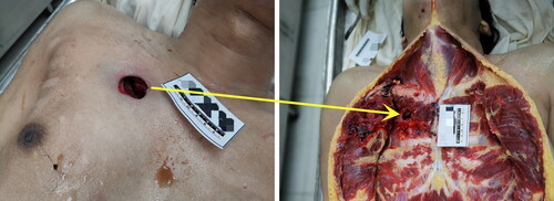 Figure 3. Round laceration wound on the right chest.