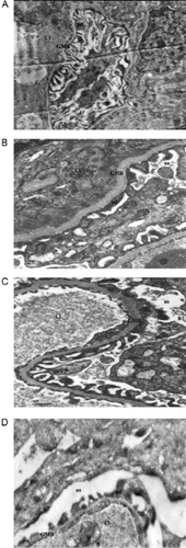 Figure 1. Glomeruli from healthy (A), diabetic (B), pentoxifylline-treated diabetic rats (C), and vitamin-E-treated diabetic rats (D). (Magnification × 7700). Abbreviation US = urinary space, d = capillary lumen, GMB = glomerular membrane basal, pd = podocytes.