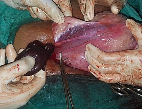 Figure 3 An intraoperative image of adnexal torsion (torsion of fimbrial cyst) at 34 weeks of gestation.