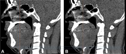 Figure 2 Images of the midsagittal view from drug-induced sleep computed tomography were collected and categorized into (A) epiglottic collapse (attach to the posterior pharyngeal wall) and (B) non-epiglottic collapse.