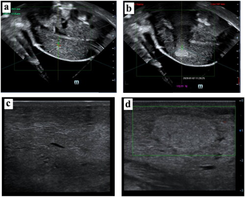 Figure 4. The US imaging of the goat mammary gland. (a) hypoechoic US imaging characteristics of the mammary gland before sonication. (b) hyperechoic scale change of US imaging appeared in the focus region after the JCQ-B transducer sonication (sonication energy: 6000 J). The US images of normal tissue (c) versus post-ablation tissue (d) in the mammary gland 7 days after sonication.