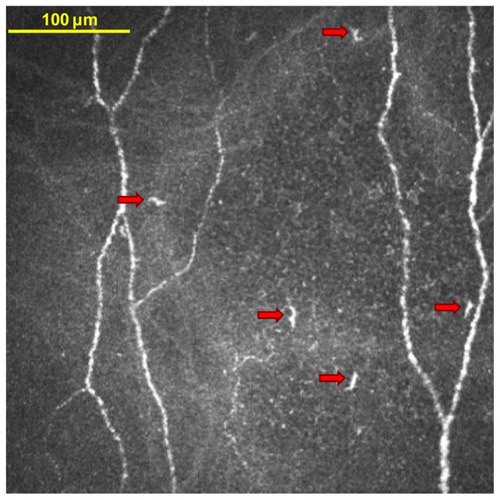 Figure 2 In vivo confocal microscopy image of dendritic immune cells in the central cornea. This image is from a study participant who habitually wore silicone hydrogel soft contact lenses and who used a polyquaternium-1 and myristamidopropyl dimethylamine solution to care for the lenses. The five features that are marked by arrows were tagged by the investigator as dendritic immune cells.