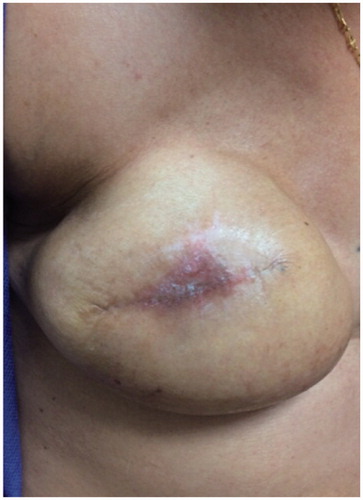 Figure 2. Clinical features of nummular eczema (Case 2). Erythematous, scaly, crusted plaque on the right mid-breast over the tissue expander port.