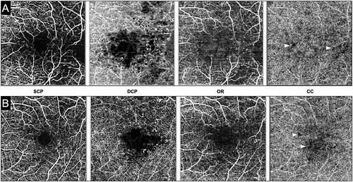 Figure 2. Optical coherence tomography angiography (OCTA) of two patients with diabetic macular edema. The layers of the OCTA are labeled as follows: SCP – superficial retinal capillary plexus; DCP – deep retinal capillary plexus; OR – outer retina; CC – choriocapillaris. Both patients #1 (A) and #2 (B) show an increase in the foveal avascular zone area and perifoveal increase in the flow deficit areas in the retinal microvasculature. Notably, the CC slab in both the patients shows areas of flow deficit (white arrowheads) suggestive of impaired CC perfusion.