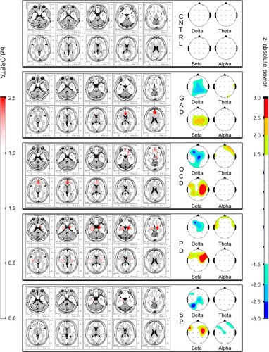 Figure 3 Group-mean maps of absolute power z-scores in the four conventional bands, and bzLORETA of the generalized anxiety disorder (GAD), obsessive–compulsive disorder (OCD), panic disorder (PD), and agoraphobia-social-specific phobia (SP) groups.
