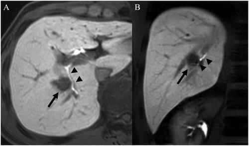 Figure 4. An infeasible case of percutaneous ablation. Gadoxetic acid-enhanced axial (A) and coronal (B) hepatobiliary phase MR images display a 1.6-cm low signal intensity hepatocellular carcinoma (arrows) abutting the right posterior hepatic duct (arrowheads) in the right liver central portion. Ablation was not performed due to a high risk of central bile duct injury.