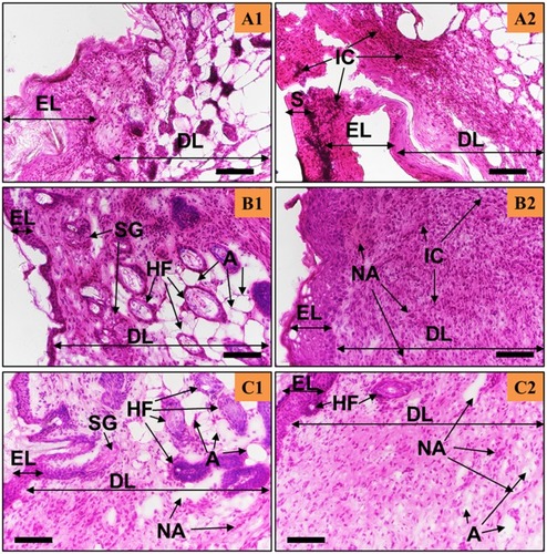 Figure 5 The Ag-Q coating improved tissue remodelling, neo-angiogenesis, and reduced inflammation. H&E staining of the skin tissues at days 7, 10, and 12 post-surgery for the CG-Ag-Q group. (A1–C1) were from the areas near the wound edge and (A2–C2) were from the areas near the middle of the wounds. Scale bars are 100 µm.Abbreviations: EL, Epidermis; DL, dermis; S, scab; IC, inflammation-mediating cells; NA, neo-angiogenesis; HF, hair follicles; SG, sebaceous glands; A, adipocytes.