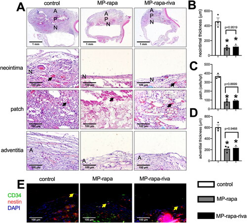 Figure 4. Deceased neointimal thickness in MP-rapa and MP-rapa-riva grafts compared to control graft in the rat inferior vena cava (IVC) patch venoplasty model at day 14. (A) Low power and high-power photographs of H&E staining of the patches harvested at day 14, n = 6. P, patch; L, IVC lumen; A, adventitial (peritoneal) surface; N, neointima. Black arrow showing the collagen and chitosan particles in the patch and neointima; scale bar, 1 mm or 100 μm; n = 3. (B) Bar graph showing the neointimal thickness; p = 0.003, ANOVA; *, p = 0.0005 and 0.006, Tukey’s multiple comparisons test; n = 3. (C) Bar graph showing the cells infiltrated into the patch (mean number of cells counted in 4 high power fields); p < 0.0001, ANOVA; *, p < 0.0001, Tukey’s multiple comparisons test; n = 3. (D) Bar graph showing decrease adventitial thickness; p = 0.0004, ANOVA; *, p = 0.0006 and 0.008, Tukey’s multiple comparisons test; n = 3. (E) Merged immunofluorescence photograph of CD34 (green), nestin (red) and DAPI (blue), yellow arrow showing the positive cell; scale bar, 100 μm; n = 3.