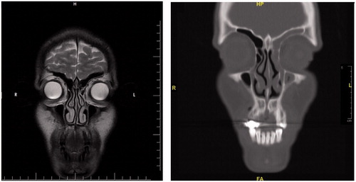Figure 12. The comparison of the preoperative MR images (left) and the postoperative CT images (right). In the tomography of the patient, the opacification and atelectasis of the left maxillary, the left frontal and the left ethmoid sinuses are seen together in the coronal section. Also, the lateral displacement of the middle concha can be noted in the postoperative CT image.
