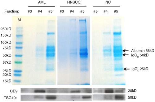 Fig. 1.  The protein content of vesicle-containing fractions after mini-SEC of cancer patients’ or normal donors’ plasma. 50 µg aliquots of each fraction (unconcentrated) were separated by PAGE and gels were stained with a Coomassie blue dye. Exosomes were visualized in western blots using anti-CD9- and anti-TSG101-specific Abs. The #3 fraction contains little protein but vesicles are present as shown by TEM in Fig. 2. Fractions #4 and #5 are enriched in exosomes but contain protein bands. Note that the heavy chain of IgG and albumin are the major proteins in fractions # 5, while fractions #3 and #4 are relatively free of IgG and albumin. Shown are representative data from 1 of more than 15 PAGE performed with different column eluates.