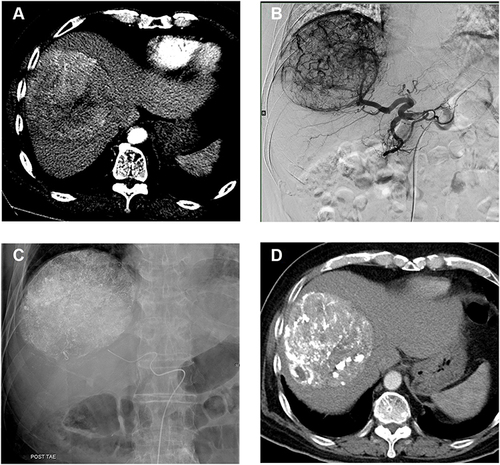 Figure 2 A 63-year-old male receiving combined ethanol-Lipiodol mixture and DEB-TACE. (A) The initial CT image on arterial phase showed a large enhancing tumor measuring 11.15 cm in right lobe. (B) Common hepatic arteriography showed hypervascular tumor staining. (C) Angiogram after selective embolization of the tumor-feeding arteries showed complete devascularization of the tumor. (D) Follow up CT at 1 month showed Lipiodol deposition within the tumor.